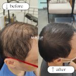 SMP for Full & Bald Head